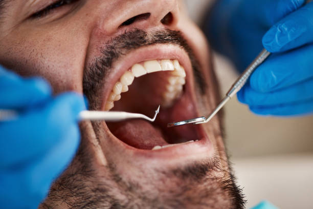 Best Emergency Dental Care for Broken or Chipped Teeth in Orida Gulf Coast University, FL